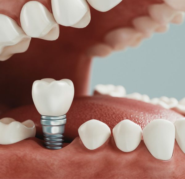 cirugia-con-implantes-dentales-luciano-badanelli-01